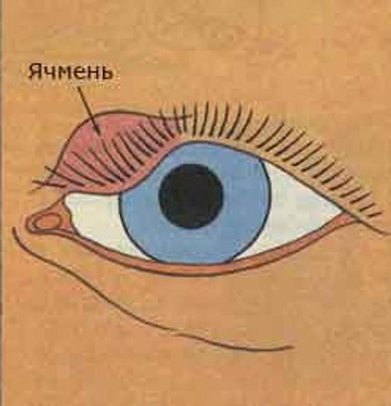 Что находится внутри ячменя на глазу Стадии Ячменя На Глазу В Картинках Развития - Telegraph