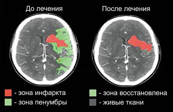 Пенумбра как сохраняться