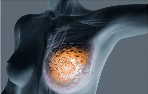 Нейросетевая модель распознает рак груди по рентгеновским снимкам