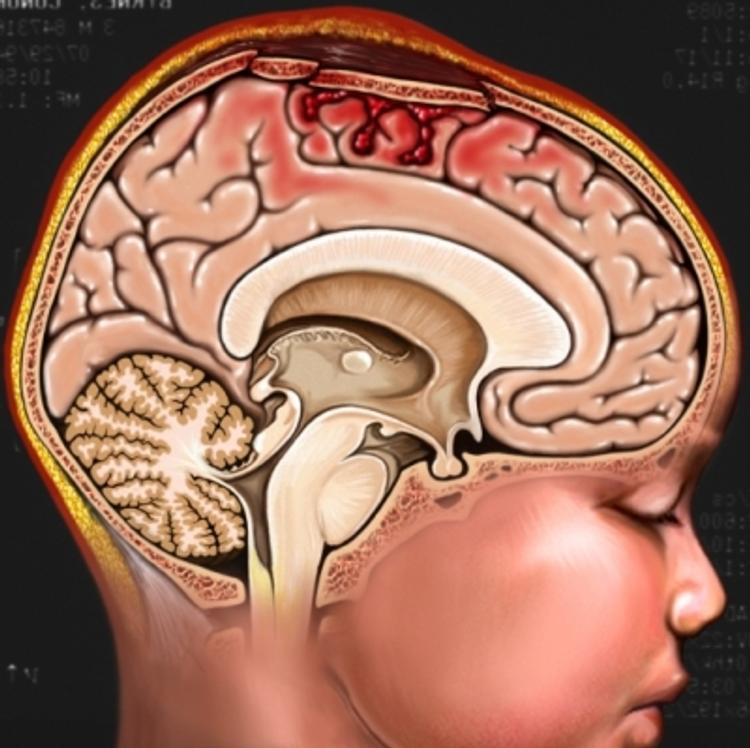 Травмы черепа и головного мозга. Черепная мозговая травма. Повреждение головы, черепно-мозговая травма.